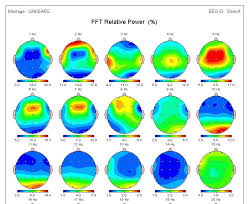 qeeg results capital district neurofeedbaack new york